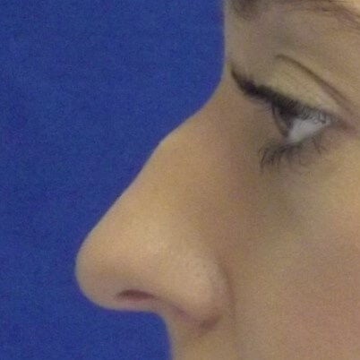 nasal bump after nose fracture